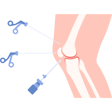 Knee Arthroscopy