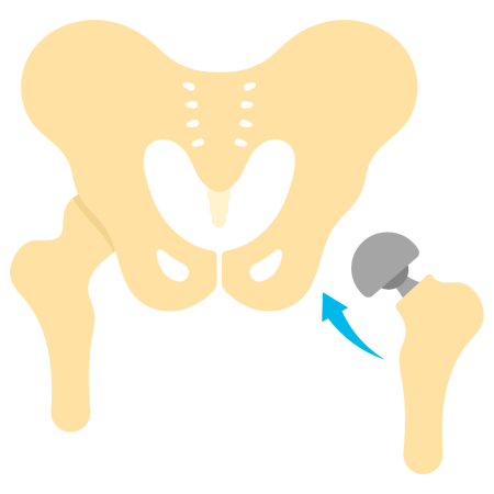 Robotic Hip Replacement Surgery