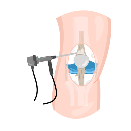 Robotic Knee Replacement