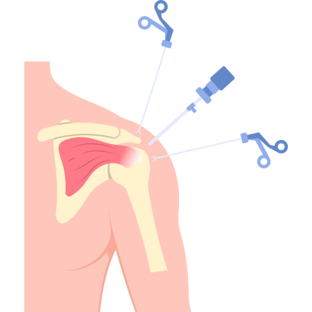 Shoulder Arthroscopy