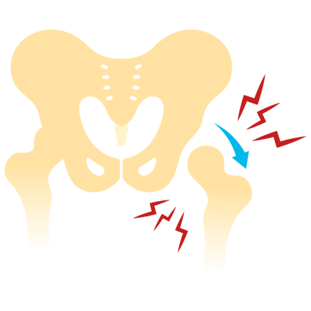 Total Hip Replacement