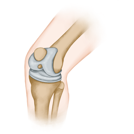 Total Knee Replacement